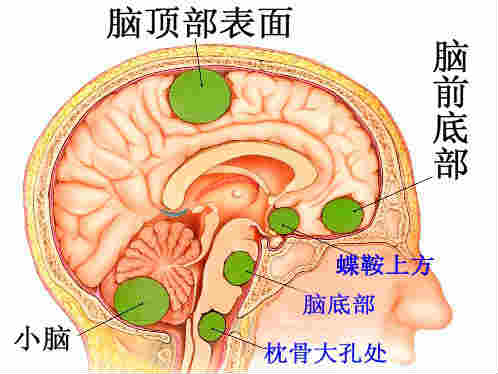 脑瘤患者术后保健要注意些什么 脑瘤术后饮食